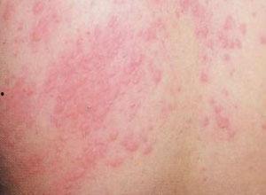 吃瓜过敏起湿疹,揭秘瓜类食物与皮肤健康的微妙关系