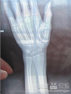 骨折可以吃小瓜吗,小瓜的适宜摄入与禁忌